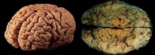 veselīga un dzeroša cilvēka smadzenes